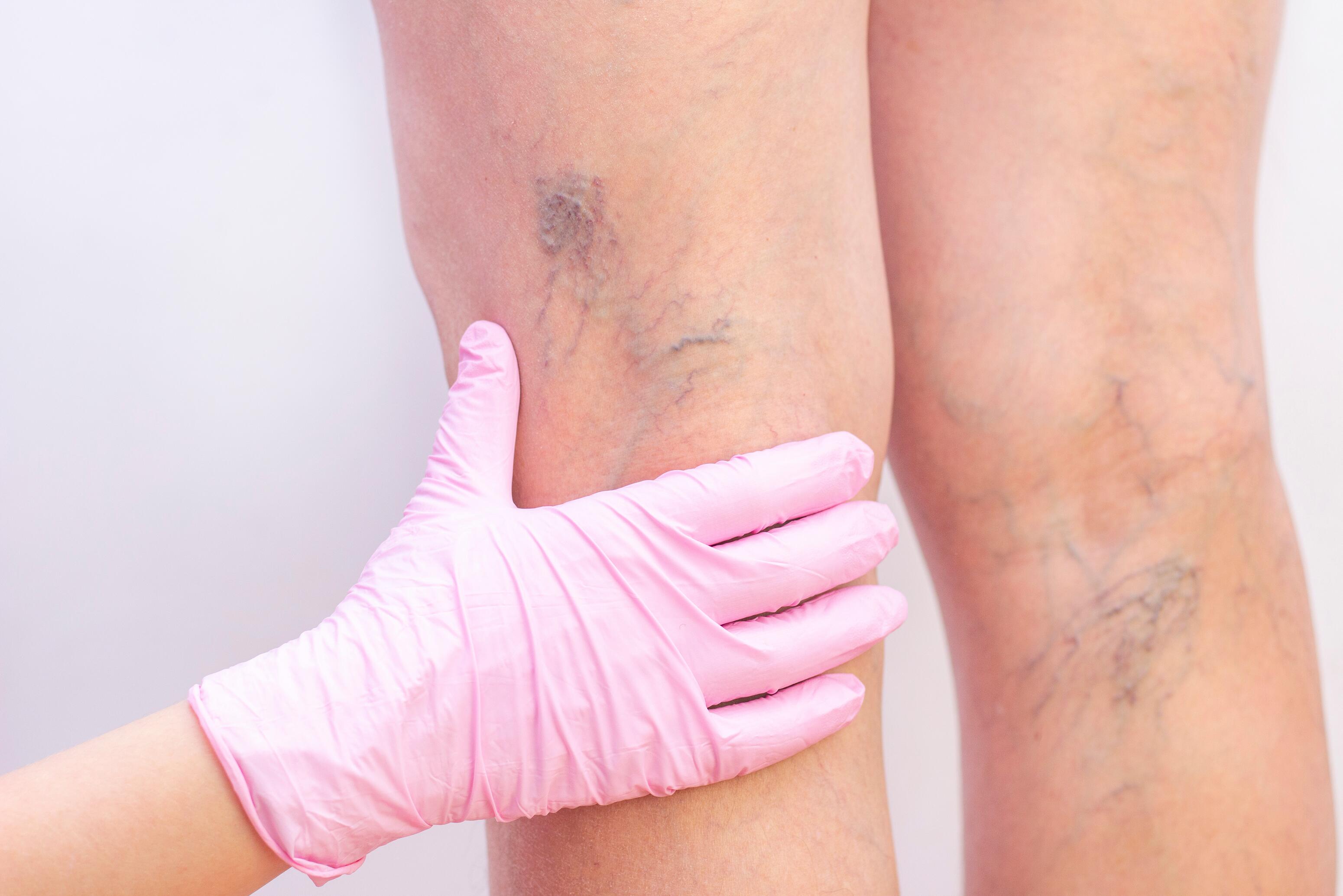 eczema varicoso delle gambe